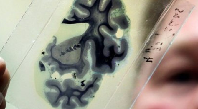 Dor Periférica Neuropática