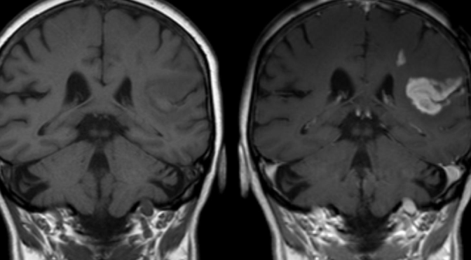 O Que é um Acidente Vascular Cerebral (AVC)